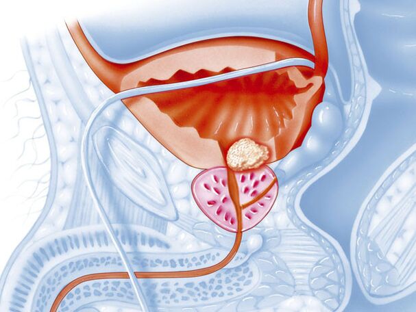 Forma bacteriană a prostatitei